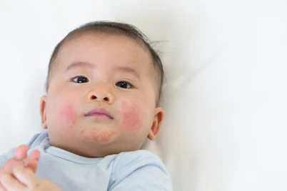 Jerawat Bayi atau Ruam? 5 Jenis dan Cara Merawatnya