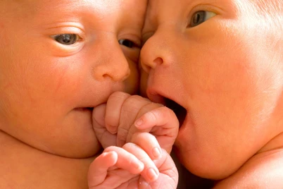 8 Jenis Bayi Kembar Siam