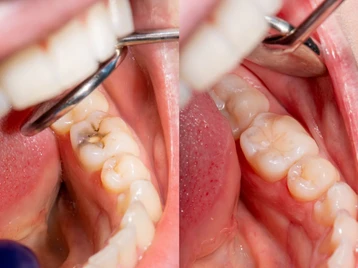 Apakah Operasi Gigi Bungsu Harus Dilakukan?