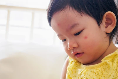 Bintik Merah pada Wajah Bayi: Penyebab dan Cara Mengatasinya
