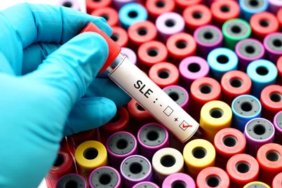 Tahap Pemeriksaan dan Diagnosis Lupus Jenis Systemic Lupus Erythematosus