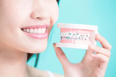 Ini Bedanya Behel Konvensional dan Invisalign