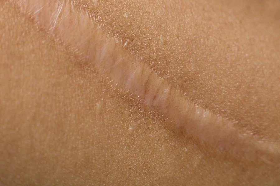 7 Cara Menyamarkan Keloid