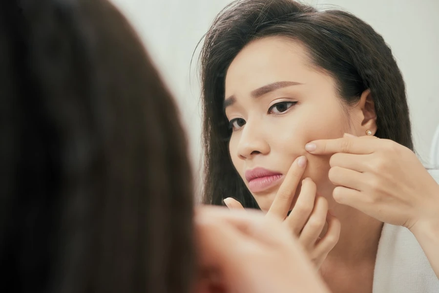 Menghilangkan Jerawat Dengan Cepat dan Efektif