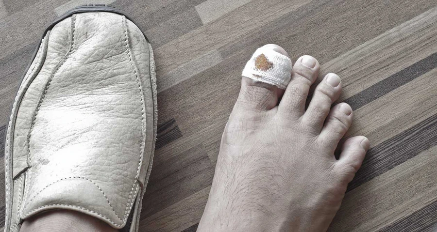 Cantengan Jempol Kaki