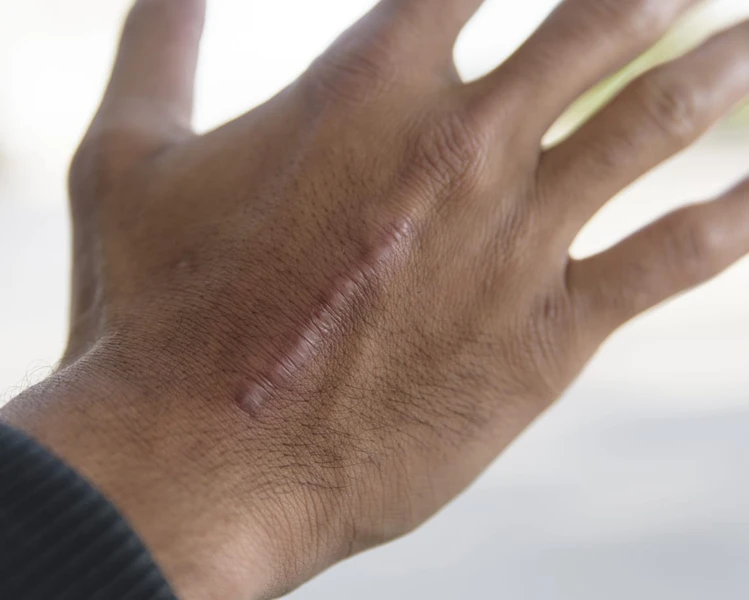Cara Menghilangkan Keloid, Terbukti Efektif!