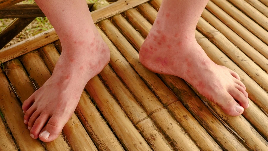 Rubella: Campak Jerman