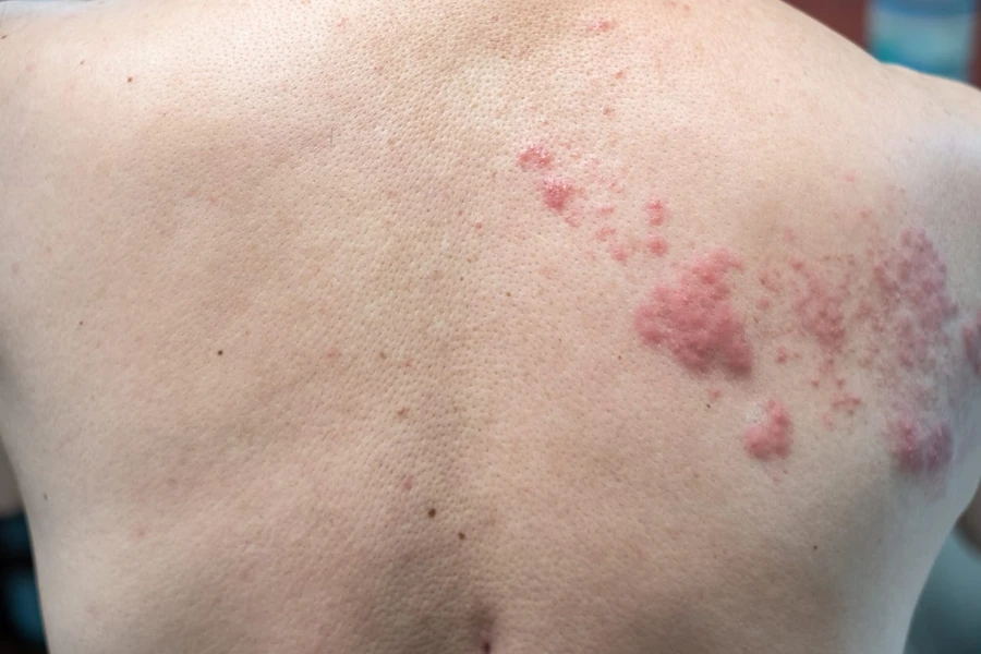 Bagaimana Cara Mengobati Herpes Zoster?