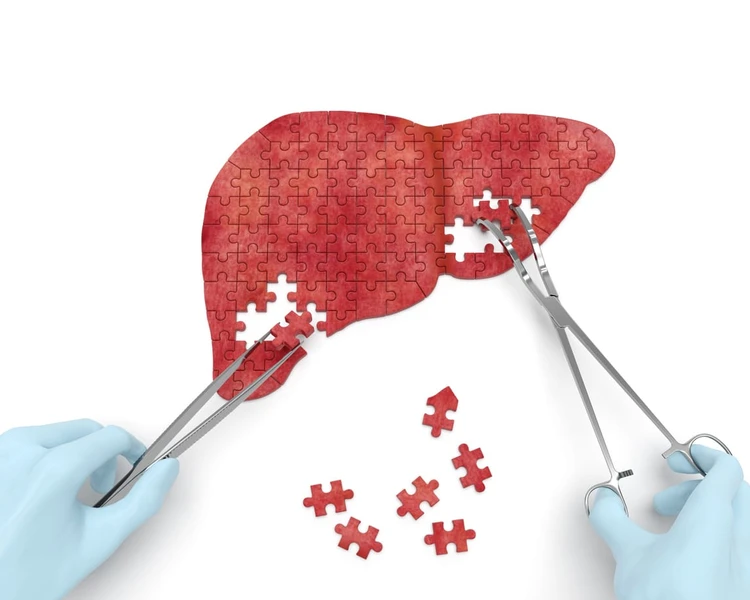 Sirosis Hati (Hepatis)