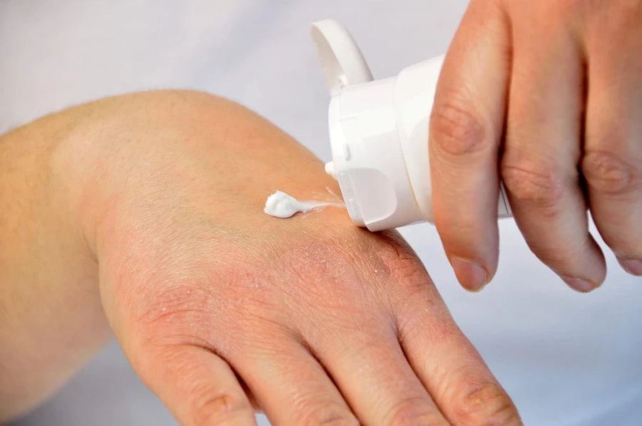 Obat Herpes Kulit (Zoster),  Bibir dan Kelamin (Simplex)