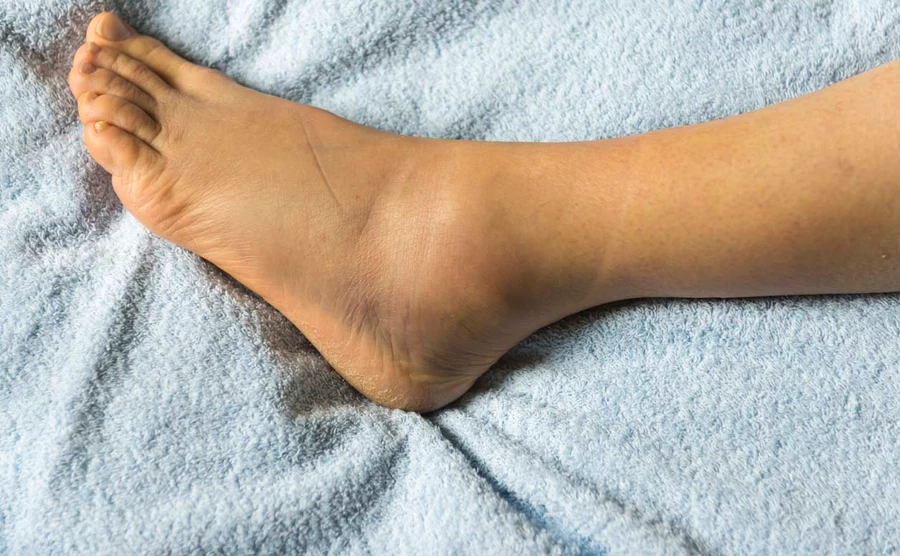 Tips Mudah Mengatasi Kaki Bengkak Secara Alami