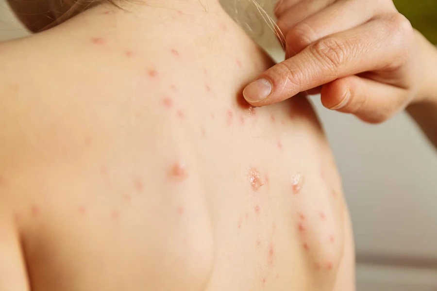 8 Penyakit Kulit Akibat Virus yang Kerap Mewabah