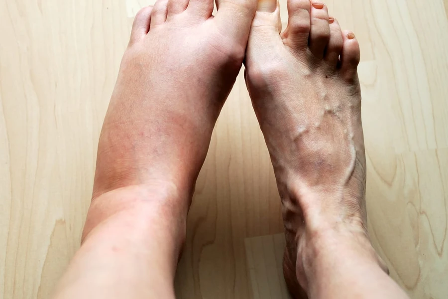 Kenapa Kalau Kaki Bengkak Posisi Kaki Harus Lebih Tinggi?