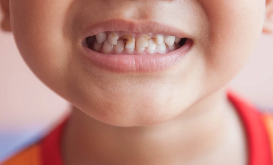 Kenali Apa Itu Baby Bottle Tooth Decay Pada Anak Bayi