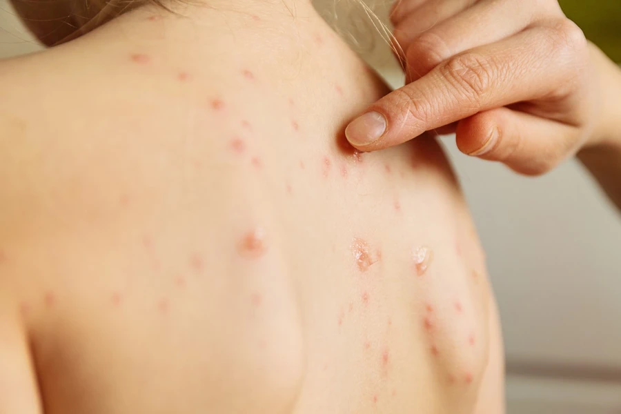 Kenali Gejala dan Cara Pencegahan Cacar Monyet (Monkeypox)