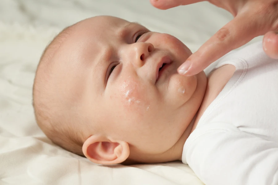 Mencubit Pipi Bayi Bisa Jadi Penyebab Dermatitis Atopik, Benarkah?