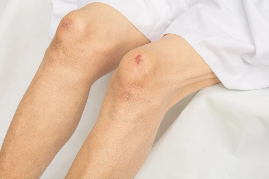Kiat  Mengobati Luka Lecet agar Lekas Sembuh