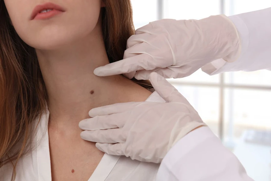 Tahi Lalat sebagai Tanda Kanker Melanoma
