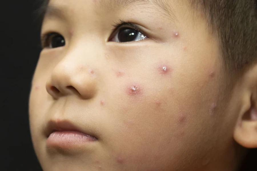 Jerawat Pada Anak: Penyebab, Gejala, dan Obat