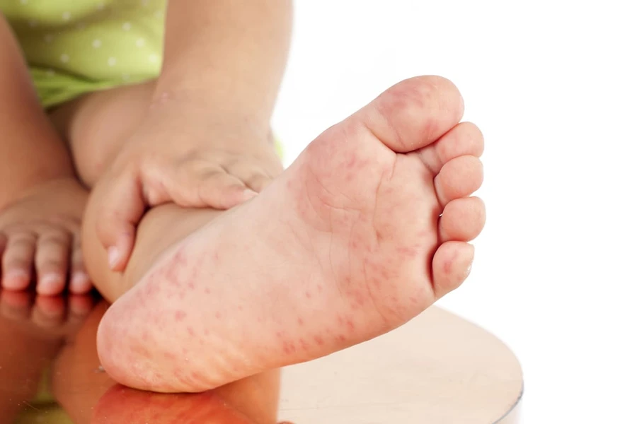 Kutu air Pada Anak: Penyebab, Gejala, dan Obat