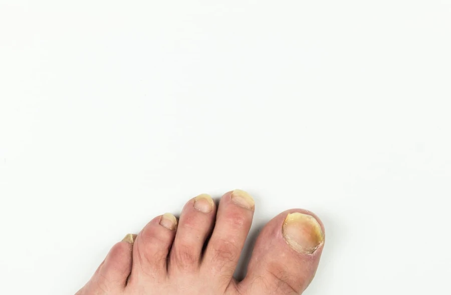 Diabetes Penyebab Kuku Kuning 