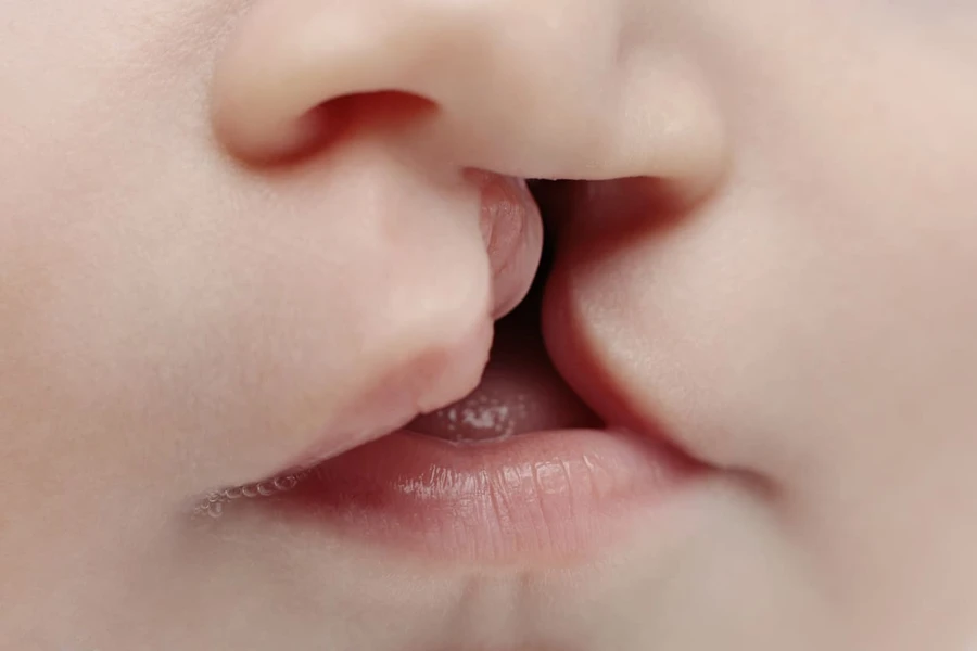 Bibir Sumbing Pada Anak: Penyebab, Gejala, dan Obat