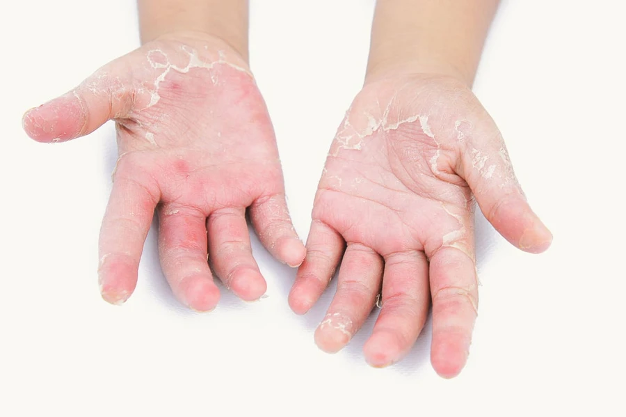 Penyebab Kulit Pecah-pecah dan Kulit Kering Pada Anak: Penyebab, Gejala, dan Obat