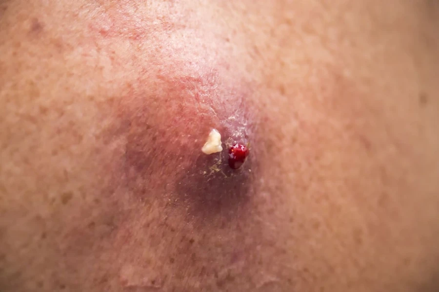 Kista Dermoid Pada Anak: Penyebab, Gejala, dan Obat