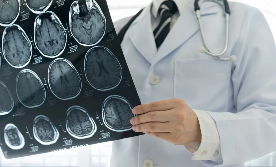 Bahaya Stroke Akibat Pembuluh Darah Pecah