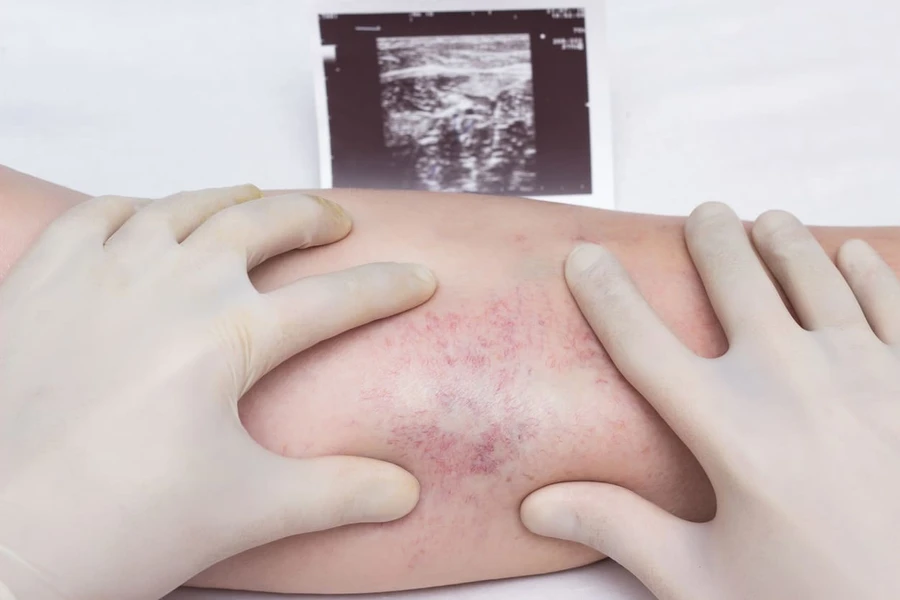 Semua yang Perlu Anda Ketahui Tentang Deep Vein Thrombosis (DVT) dan Penerbangan