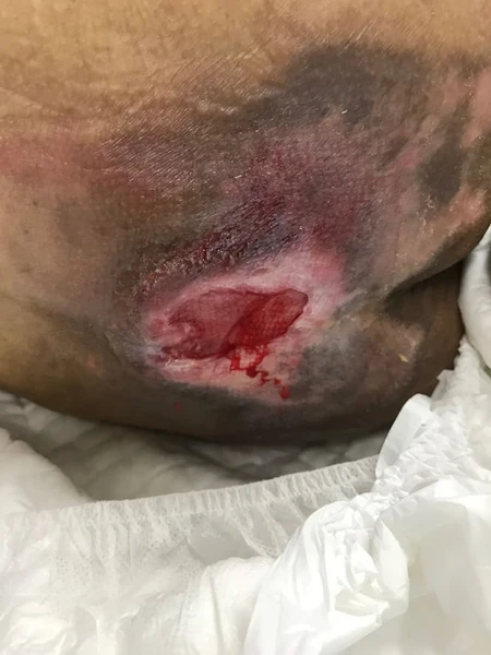 Luka Dekubitus Pasien Tirah Baring