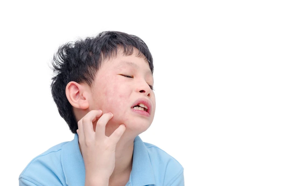 Gatal Pada Anak: Penyebab, Gejala, dan Obat