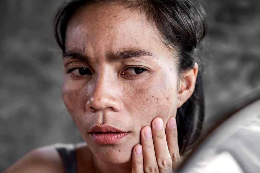 7 Cara Ampuh Menghilangkan Bintik-Bintik Cokelat di Wajah (Freckles)