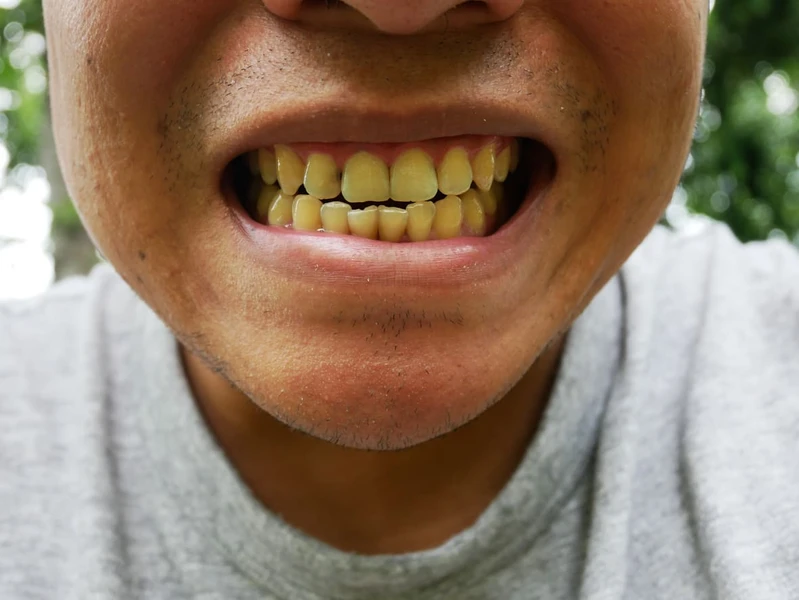 Apa Saja Penyebab Gigi Kuning?