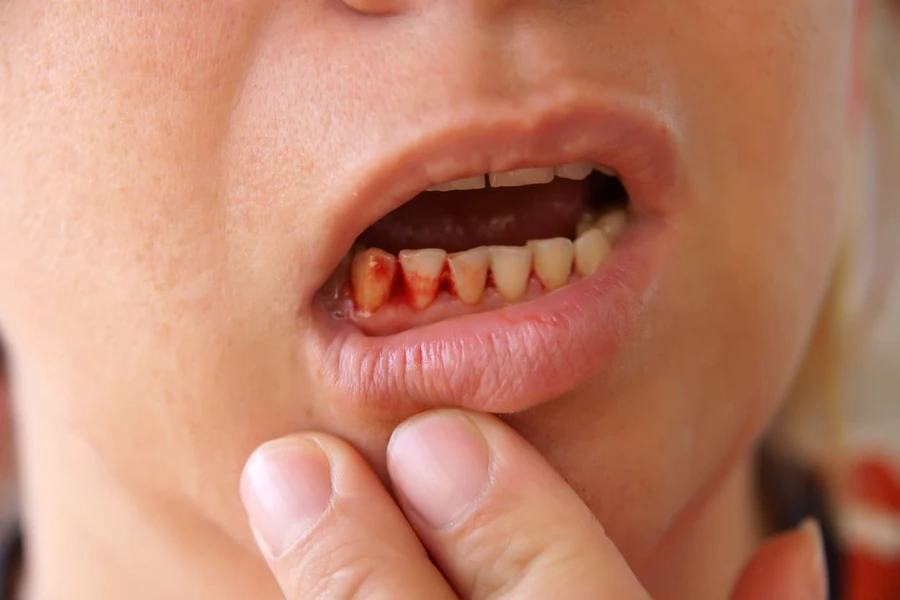 Gingivitis dan Penyakit Periodontal