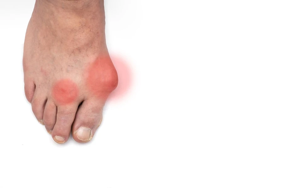 Kenali Lebih Lanjut Gejala Arthritis di Jari Kaki
