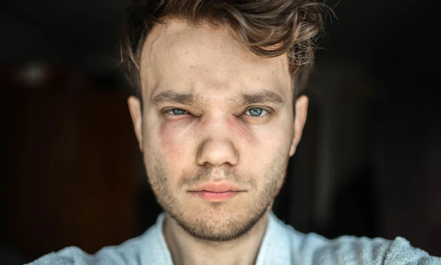 Mengenal Sindrom Angioedema