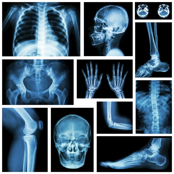 Yang Perlu Diketahui Sebelum Menjalani Scan Tulang
