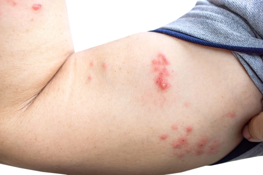 Bahaya Penyakit Cacar Ular (Herpes Zoster) pada Manusia