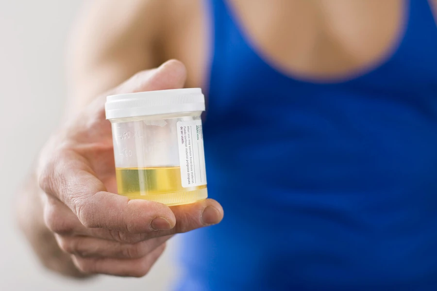 6 Arti Warna Urine, Apakah Tanda Warna Urine Normal?