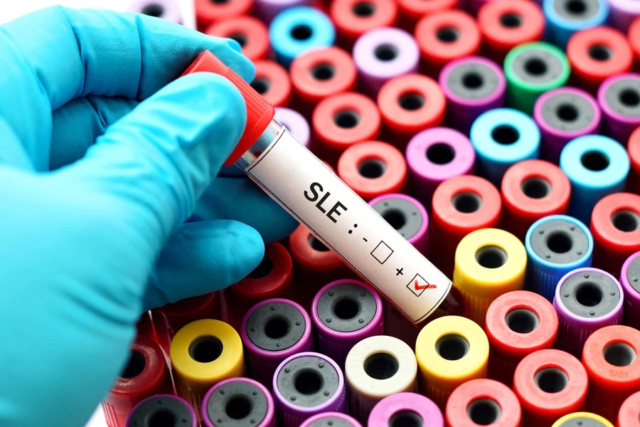 Tahap Pemeriksaan dan Diagnosis Lupus Jenis Systemic Lupus Erythematosus