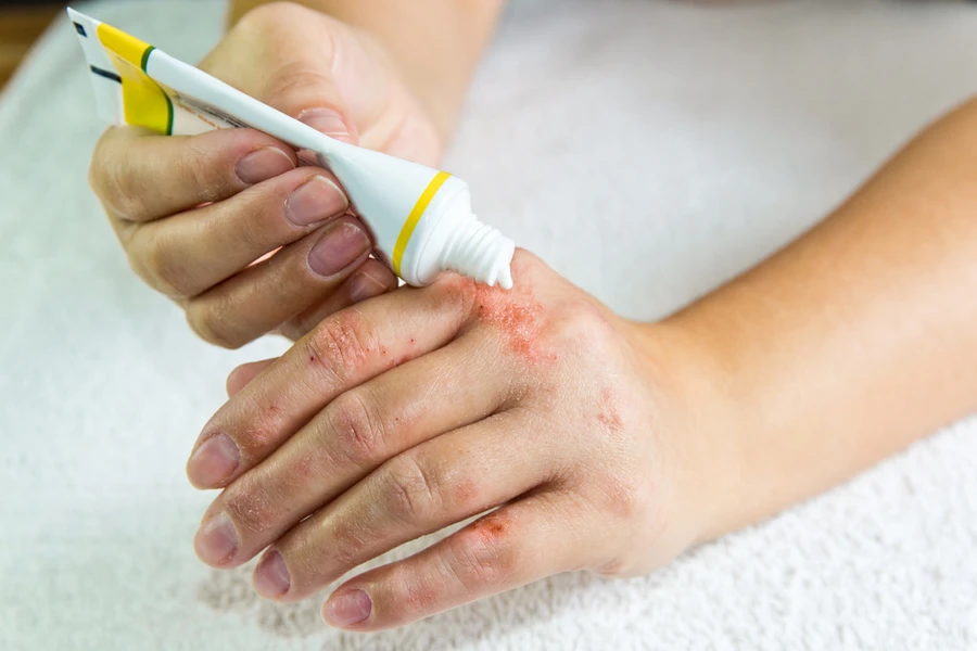3 Penyakit Kulit yang Dapat Diatasi dengan Salep Betametason