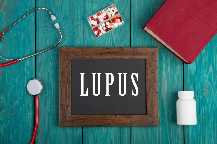 Penyakit Lupus: Pengertian, Penyebab, Gejala, dan Pengobatan
