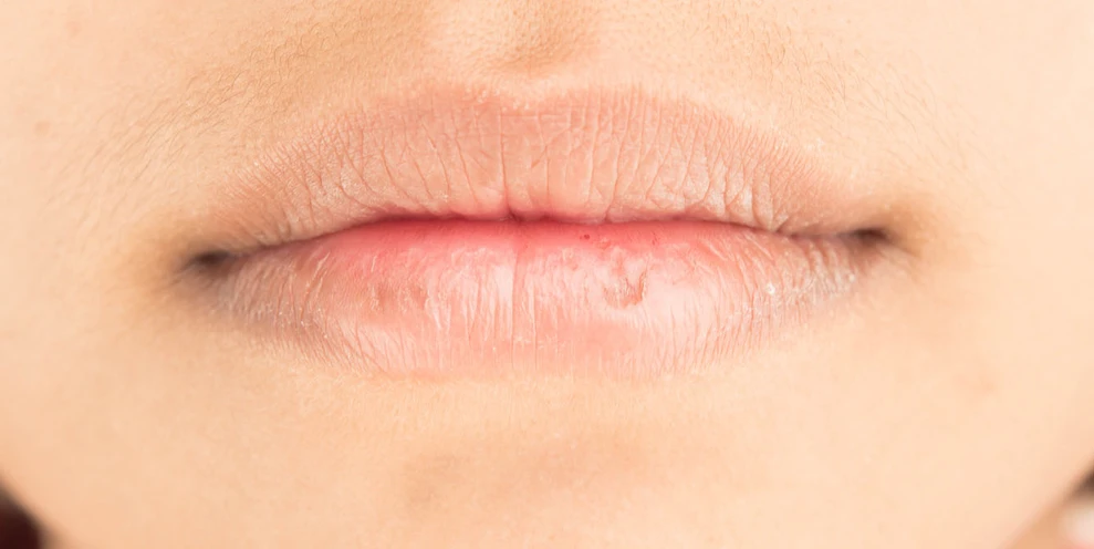 14 Cara Alami Mengatasi Bibir Kering dan Pecah-Pecah