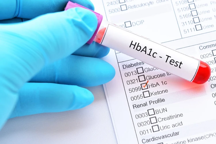 Pengertian HBA1C, Pemeriksaan dan Nilai Normal