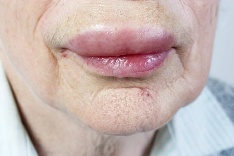 Penyebab Bibir Bengkak dan Cara Mengatasinya