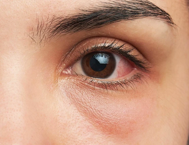12 Penyebab Mata Pedih dan Merah, Plus Cara Mengatasinya