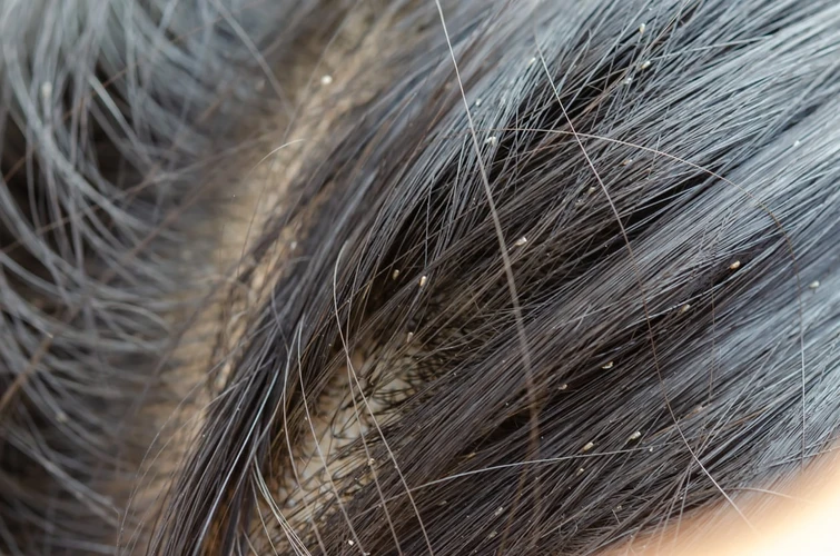 Bahaya Kutu Rambut Yang Tak Boleh Diremehkan