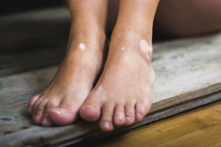 8 Jenis Pengobatan Vitiligo Yang Terbukti Manjur