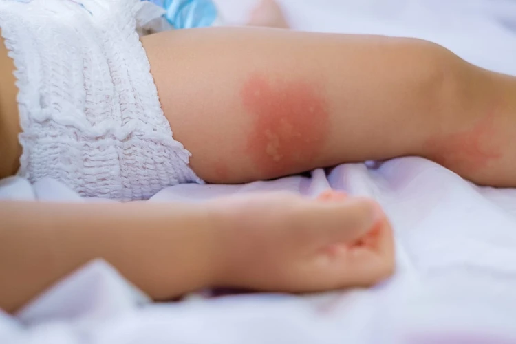 Ciri-Ciri Alergi Susu Sapi Pada Anak
